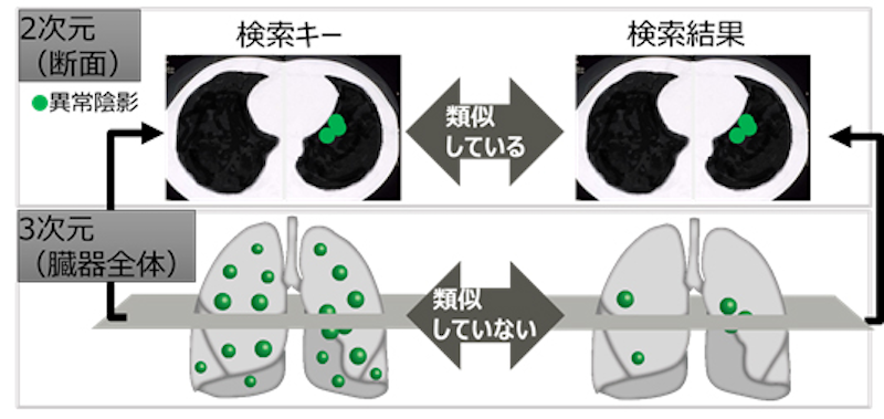 図　びまん性肺疾患の場合、1枚のCT画像から見える異常陰影の位置が似ていても、肺全体で見ると異常陰影の分布がまるで異なるということが多い