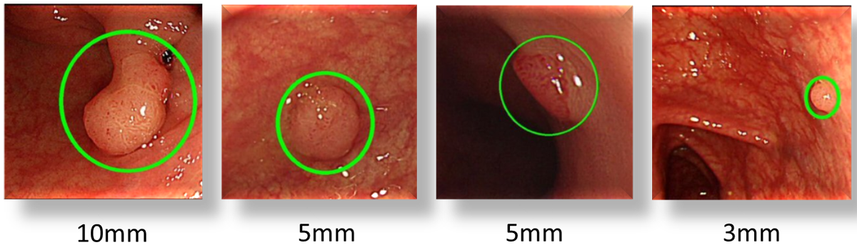 図　今回開発したシステムが検出したポリープの例
