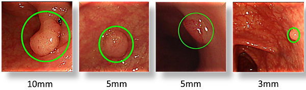 図　今回開発したシステムが検出したポリープの例